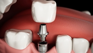 All on four tekniği ile implant tedavisi